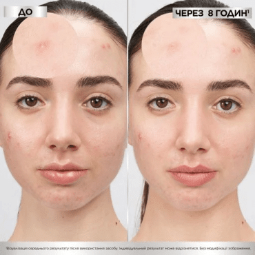 Патчи против прыщей Garnier Pure Active гидроколоидные, 22 шт фото 4